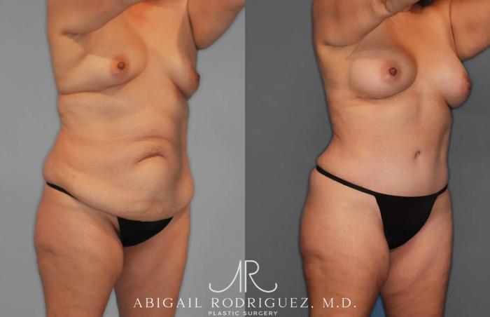 Before & After Tummy Tuck Case 259435 View 10 View in Houston, TX