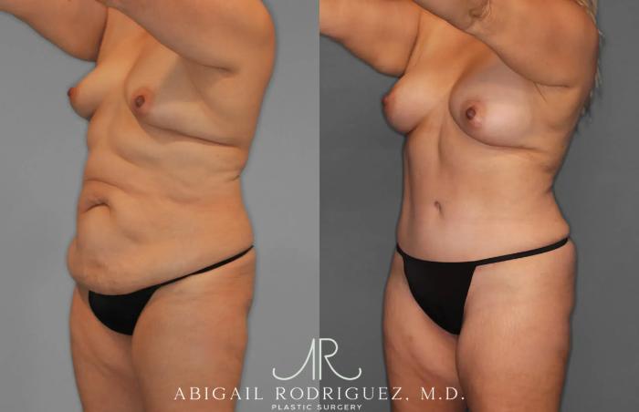 Before & After Tummy Tuck Case 259435 View 2 View in Houston, TX