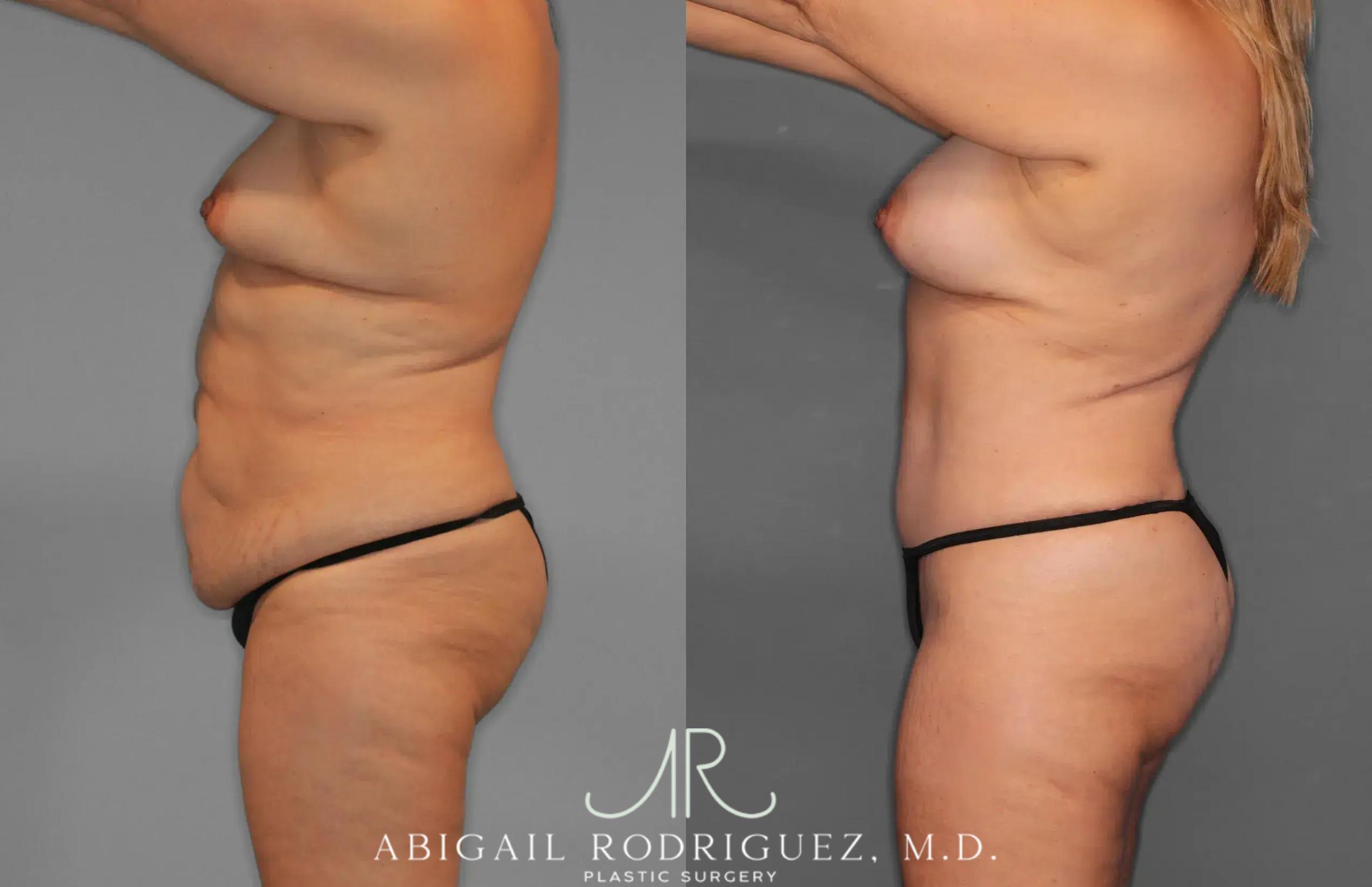 Before & After Tummy Tuck Case 259435 View 3 View in Houston, TX