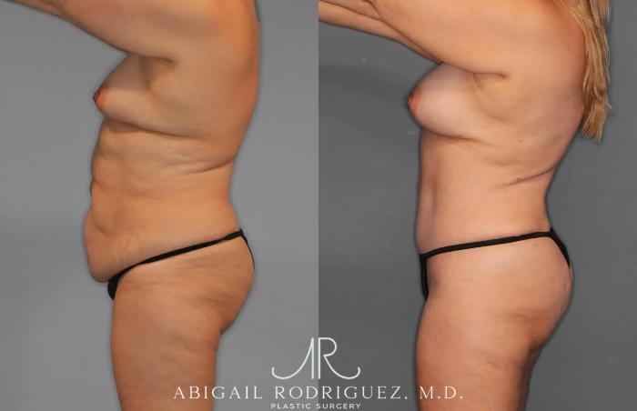 Before & After Tummy Tuck Case 259435 View 3 View in Houston, TX