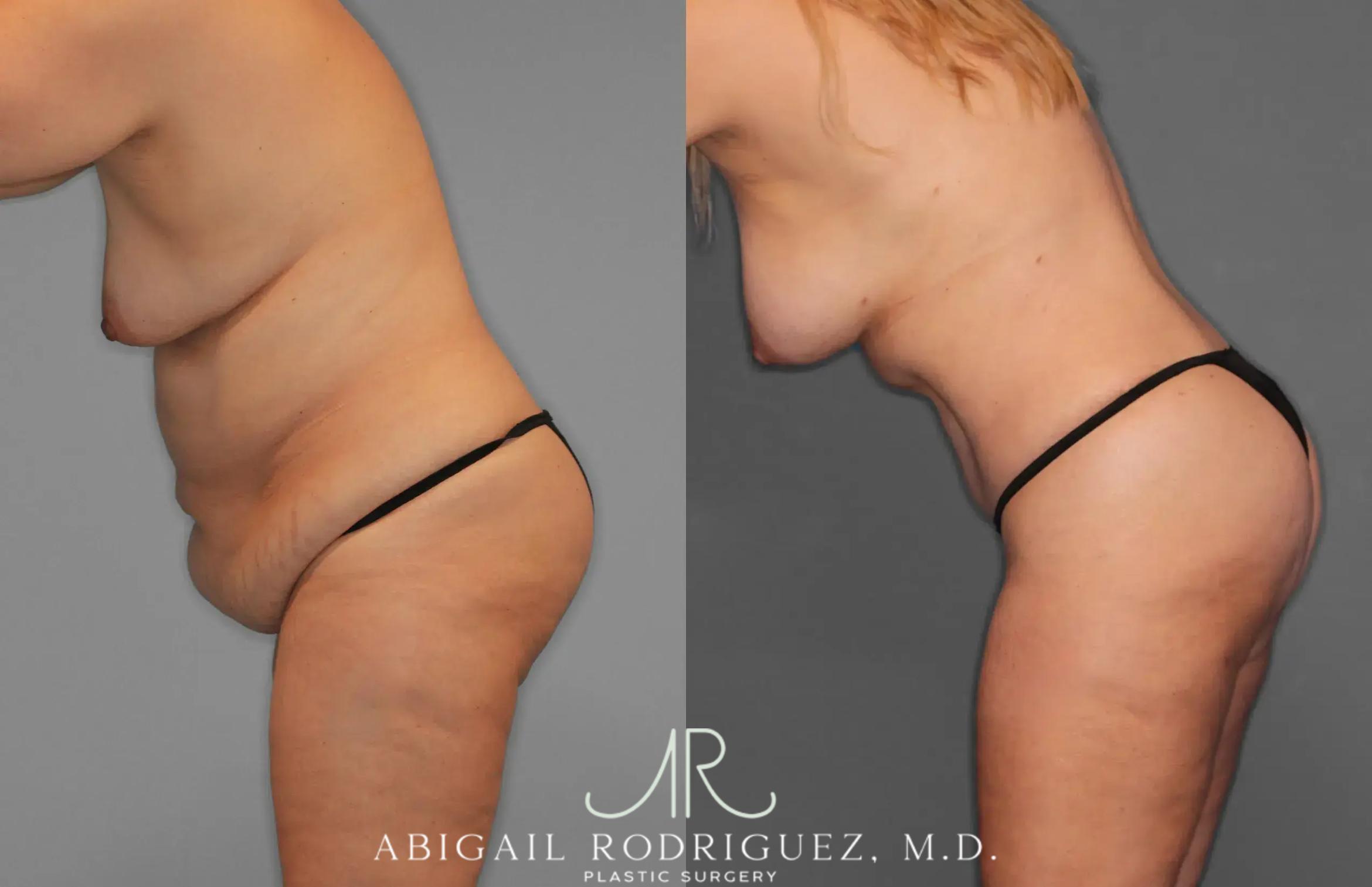 Before & After Tummy Tuck Case 259435 View 4 View in Houston, TX