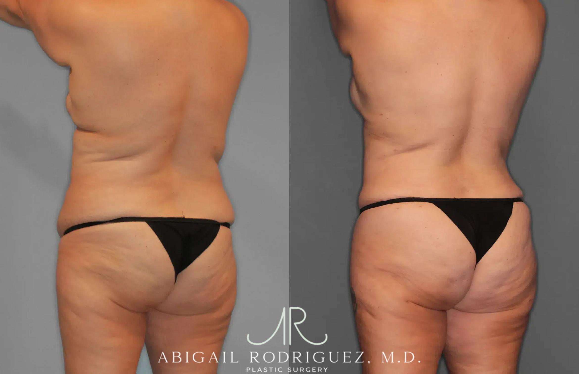 Before & After Tummy Tuck Case 259435 View 5 View in Houston, TX