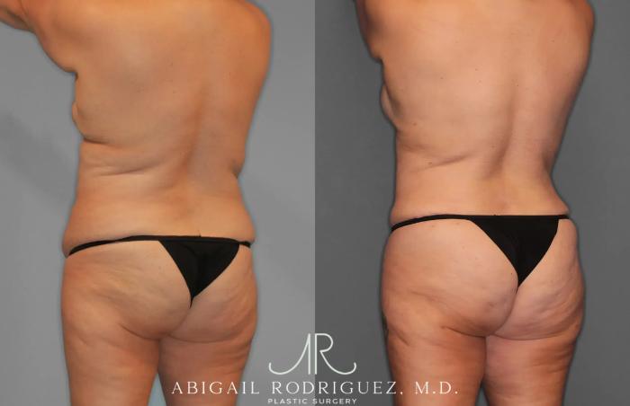 Before & After Tummy Tuck Case 259435 View 5 View in Houston, TX