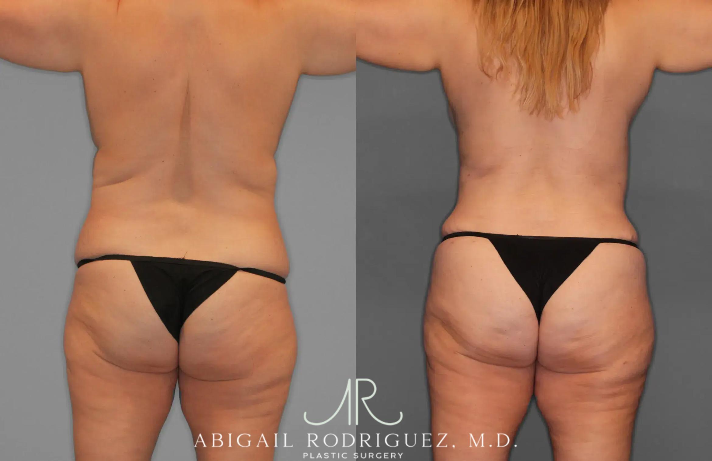 Before & After Tummy Tuck Case 259435 View 6 View in Houston, TX