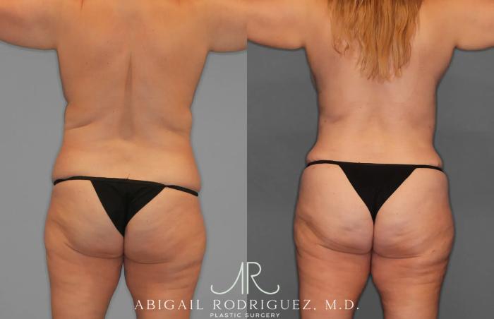 Before & After Tummy Tuck Case 259435 View 6 View in Houston, TX