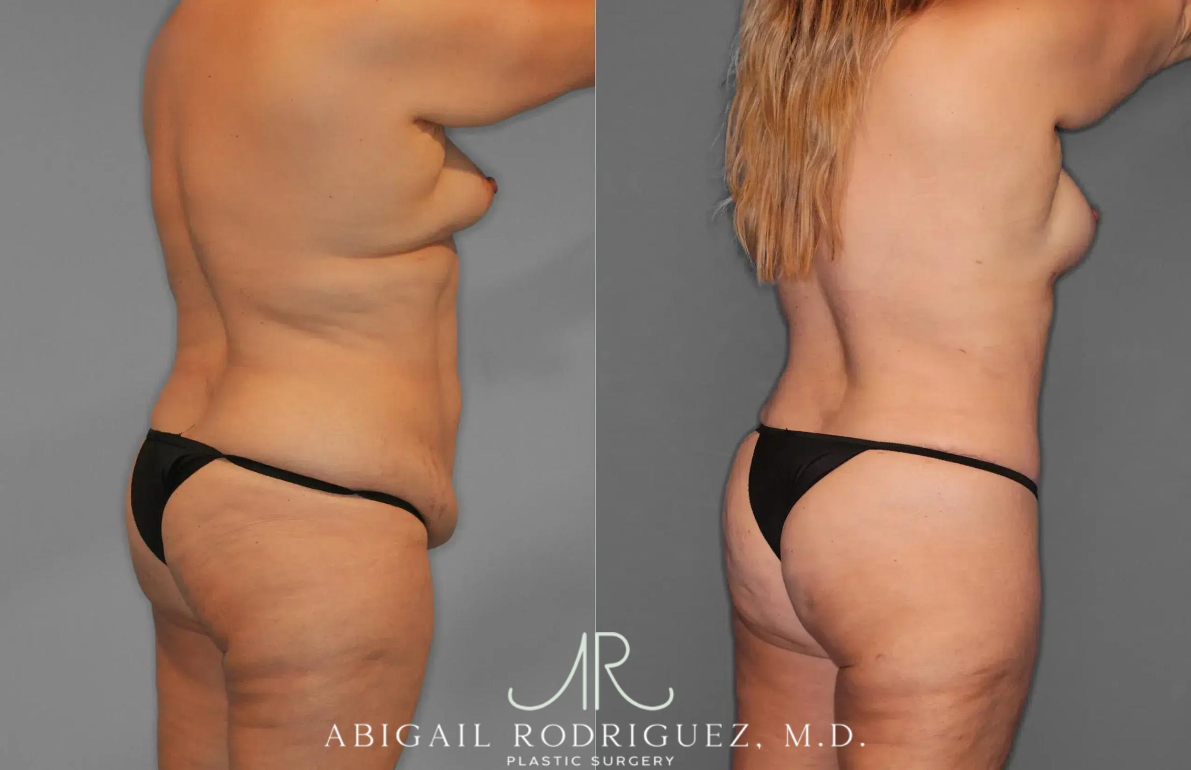 Before & After Tummy Tuck Case 259435 View 7 View in Houston, TX