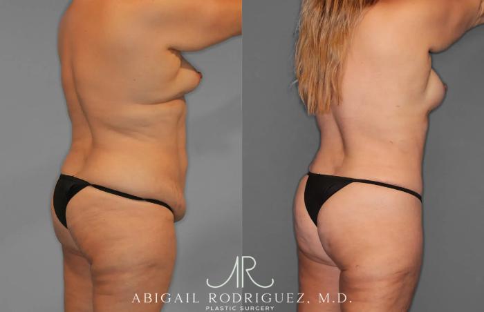 Before & After Tummy Tuck Case 259435 View 7 View in Houston, TX