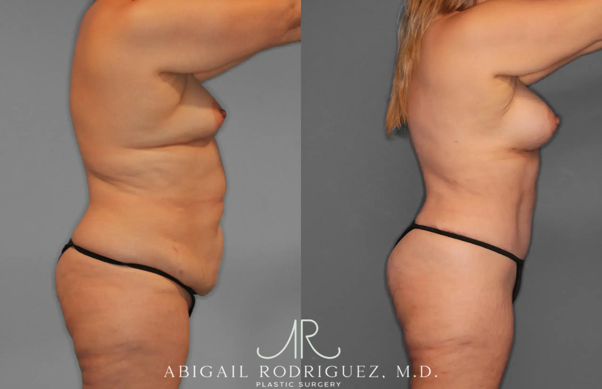 Before & After Tummy Tuck Case 259435 View 8 View in Houston, TX