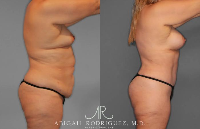 Before & After Tummy Tuck Case 259435 View 8 View in Houston, TX