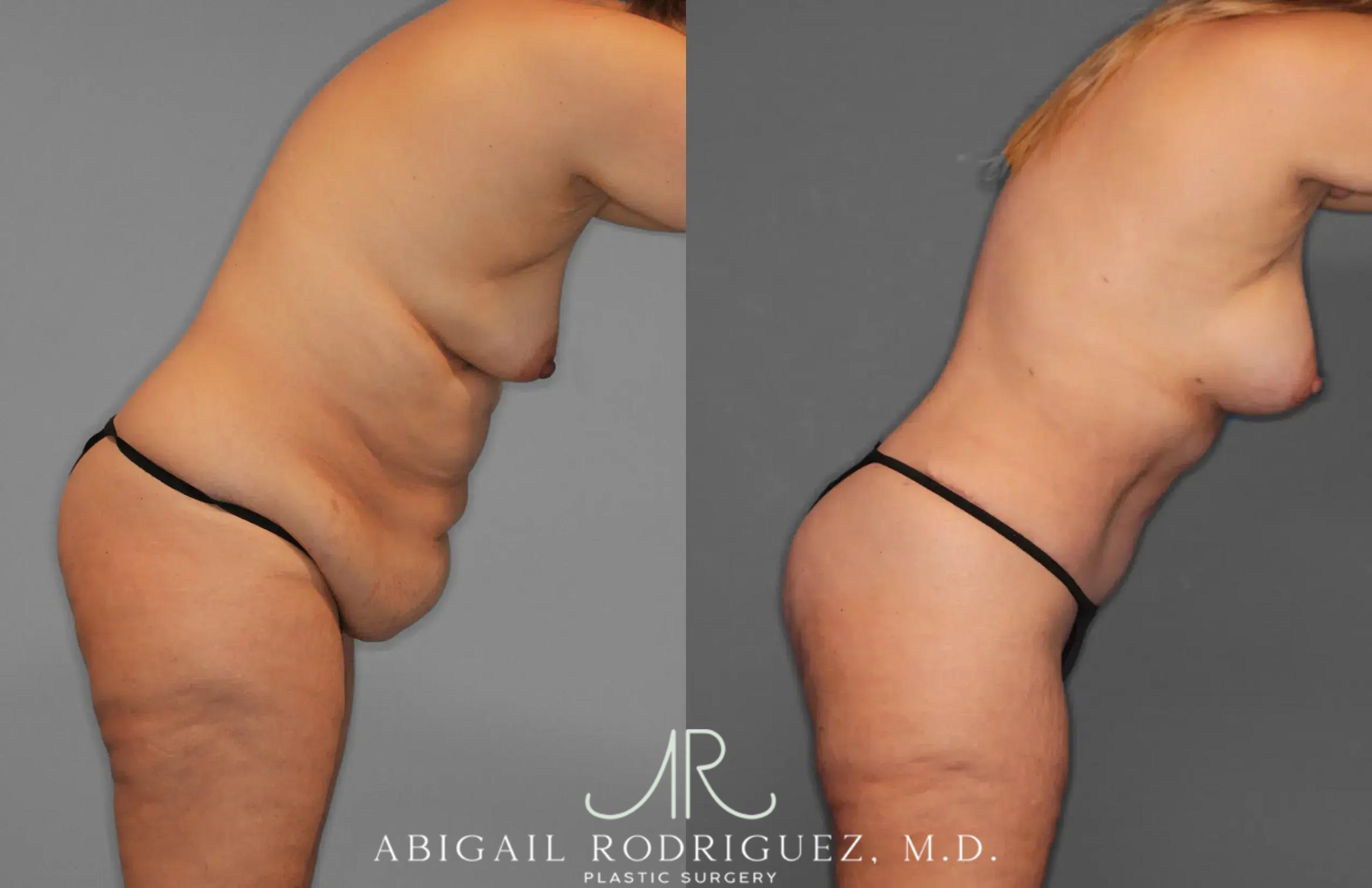 Before & After Tummy Tuck Case 259435 View 9 View in Houston, TX