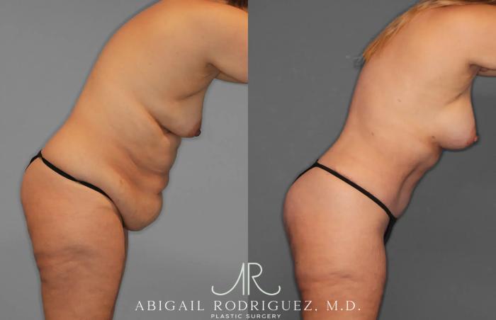 Before & After Tummy Tuck Case 259435 View 9 View in Houston, TX