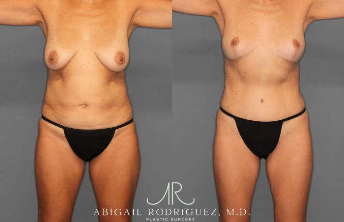 Before & After Tummy Tuck Case 259495 View 1 View in Houston, TX