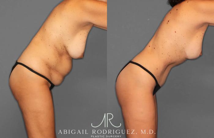 Before & After Tummy Tuck Case 259495 View 10 View in Houston, TX