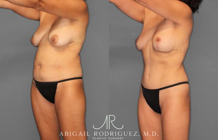 Before & After Tummy Tuck Case 259495 View 2 View in Houston, TX