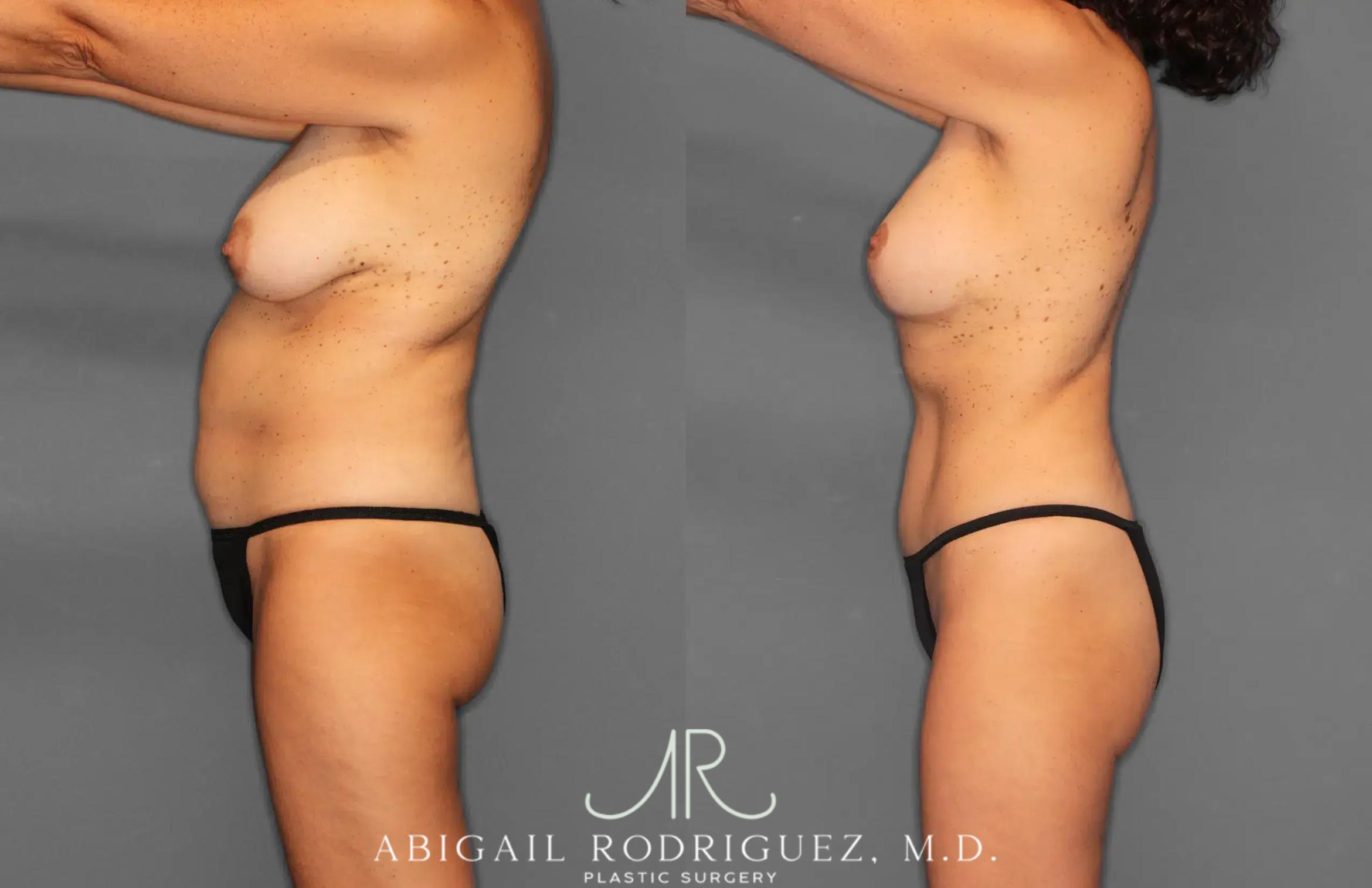 Before & After Tummy Tuck Case 259495 View 3 View in Houston, TX