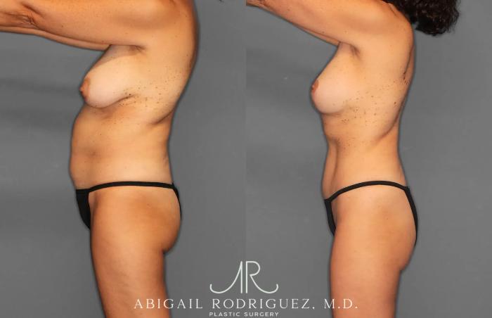 Before & After Tummy Tuck Case 259495 View 3 View in Houston, TX