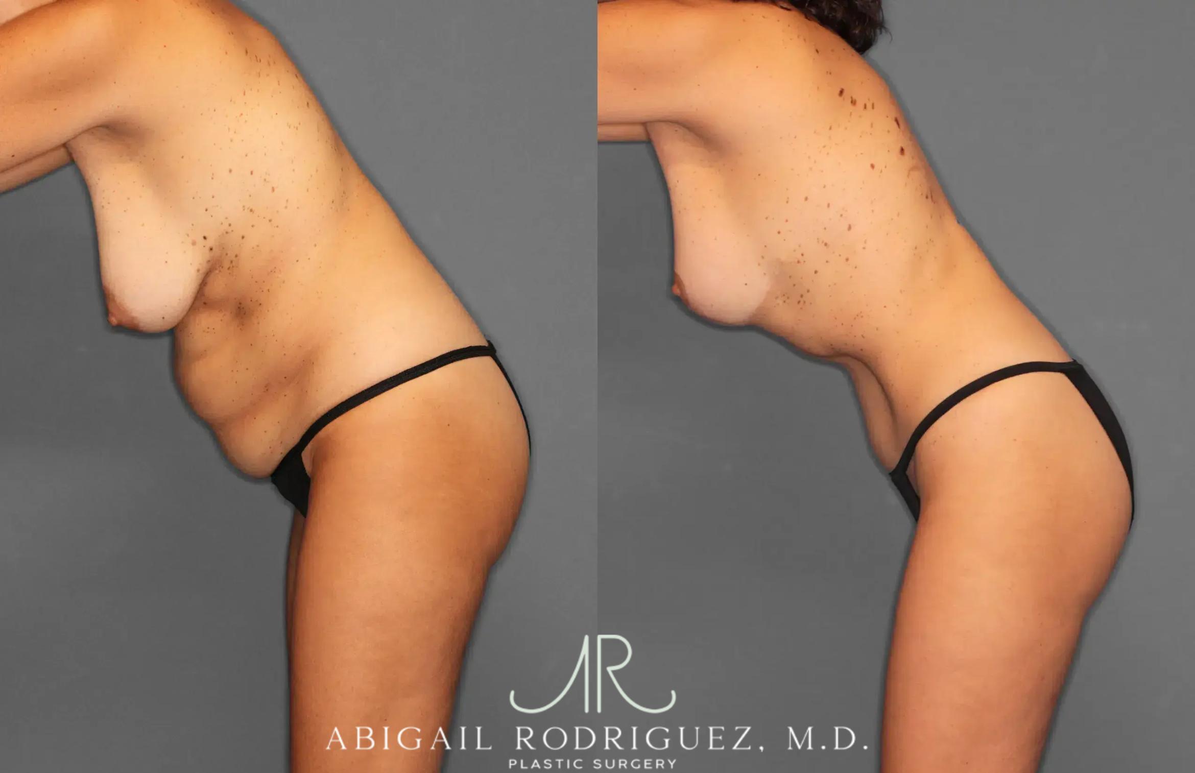 Before & After Tummy Tuck Case 259495 View 4 View in Houston, TX