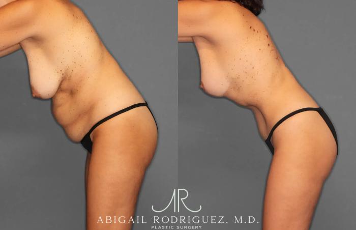 Before & After Tummy Tuck Case 259495 View 4 View in Houston, TX