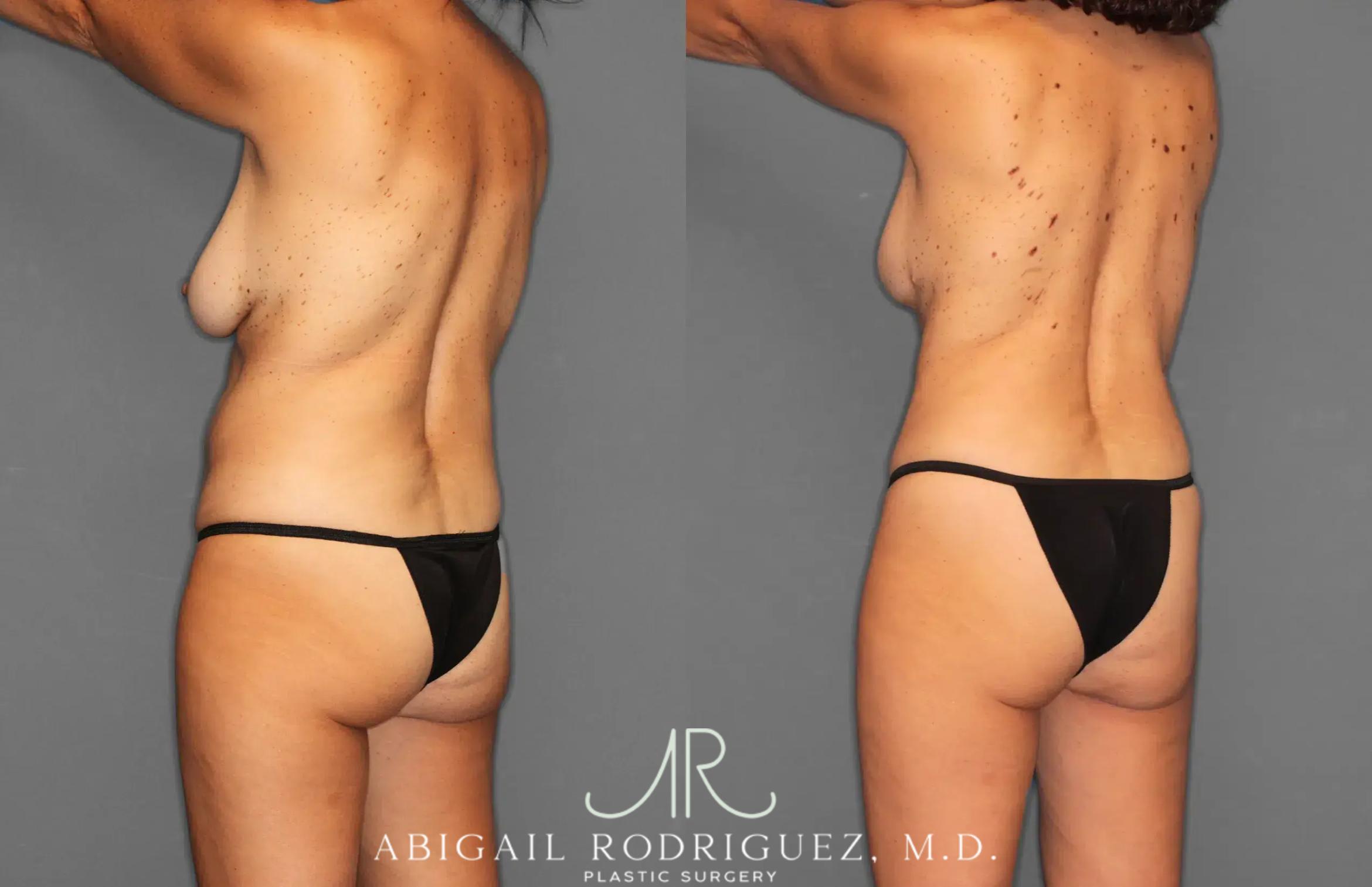 Before & After Tummy Tuck Case 259495 View 5 View in Houston, TX