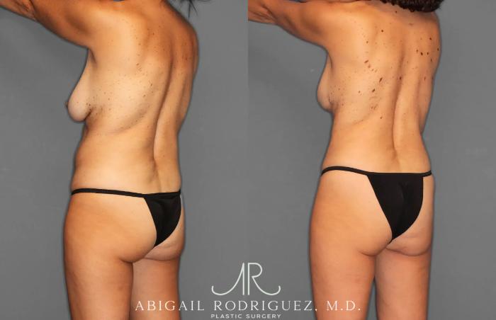 Before & After Tummy Tuck Case 259495 View 5 View in Houston, TX