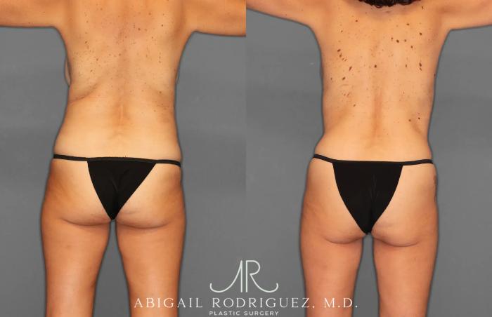 Before & After Tummy Tuck Case 259495 View 6 View in Houston, TX