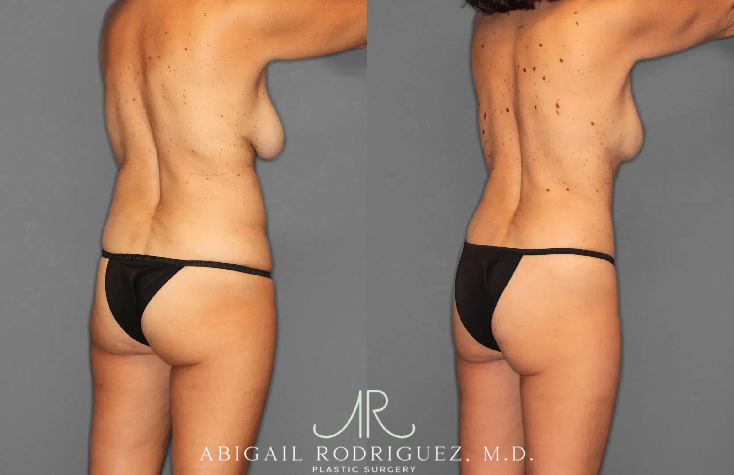 Before & After Tummy Tuck Case 259495 View 7 View in Houston, TX