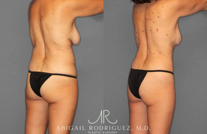 Before & After Tummy Tuck Case 259495 View 7 View in Houston, TX