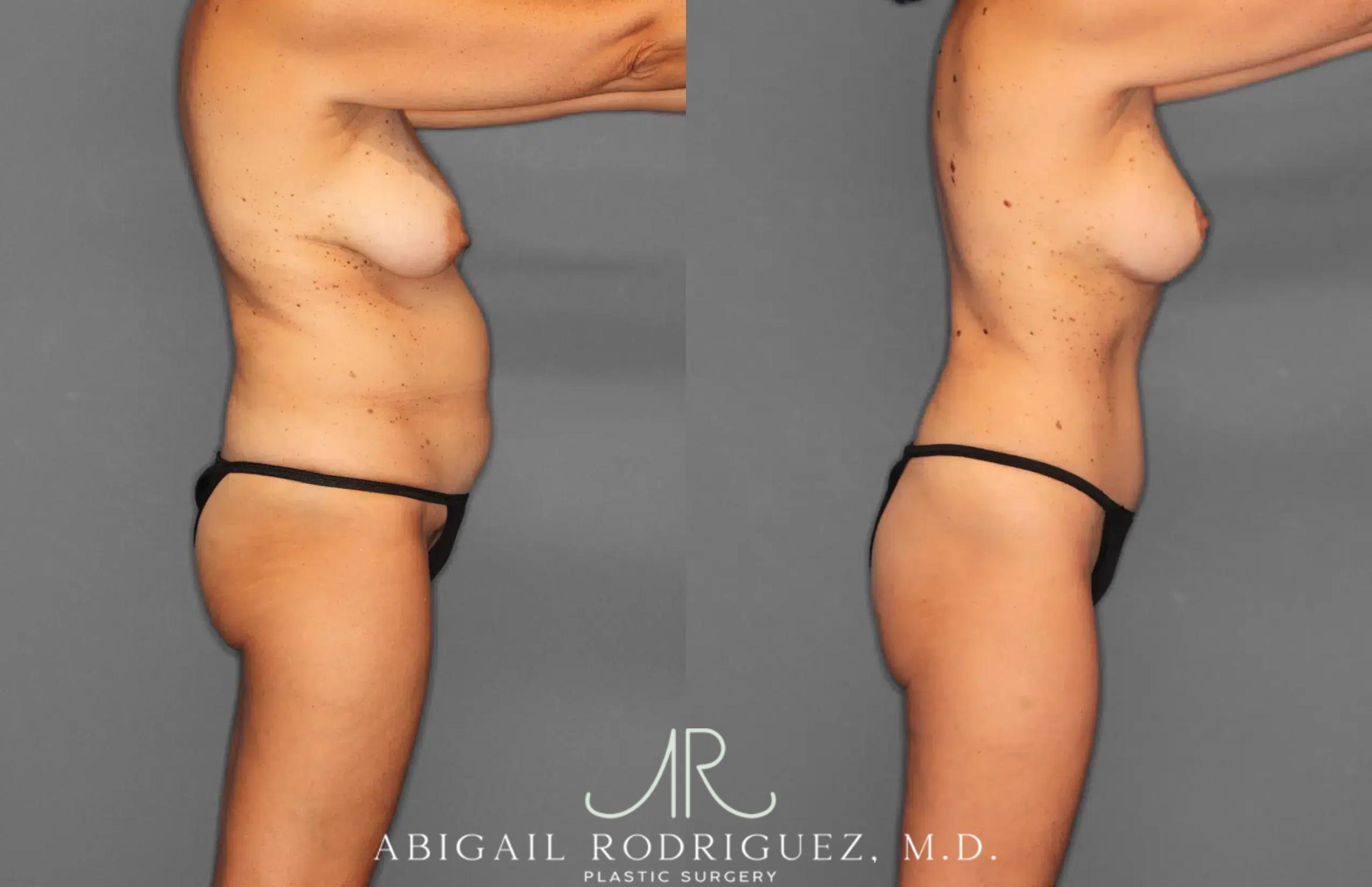 Before & After Tummy Tuck Case 259495 View 8 View in Houston, TX