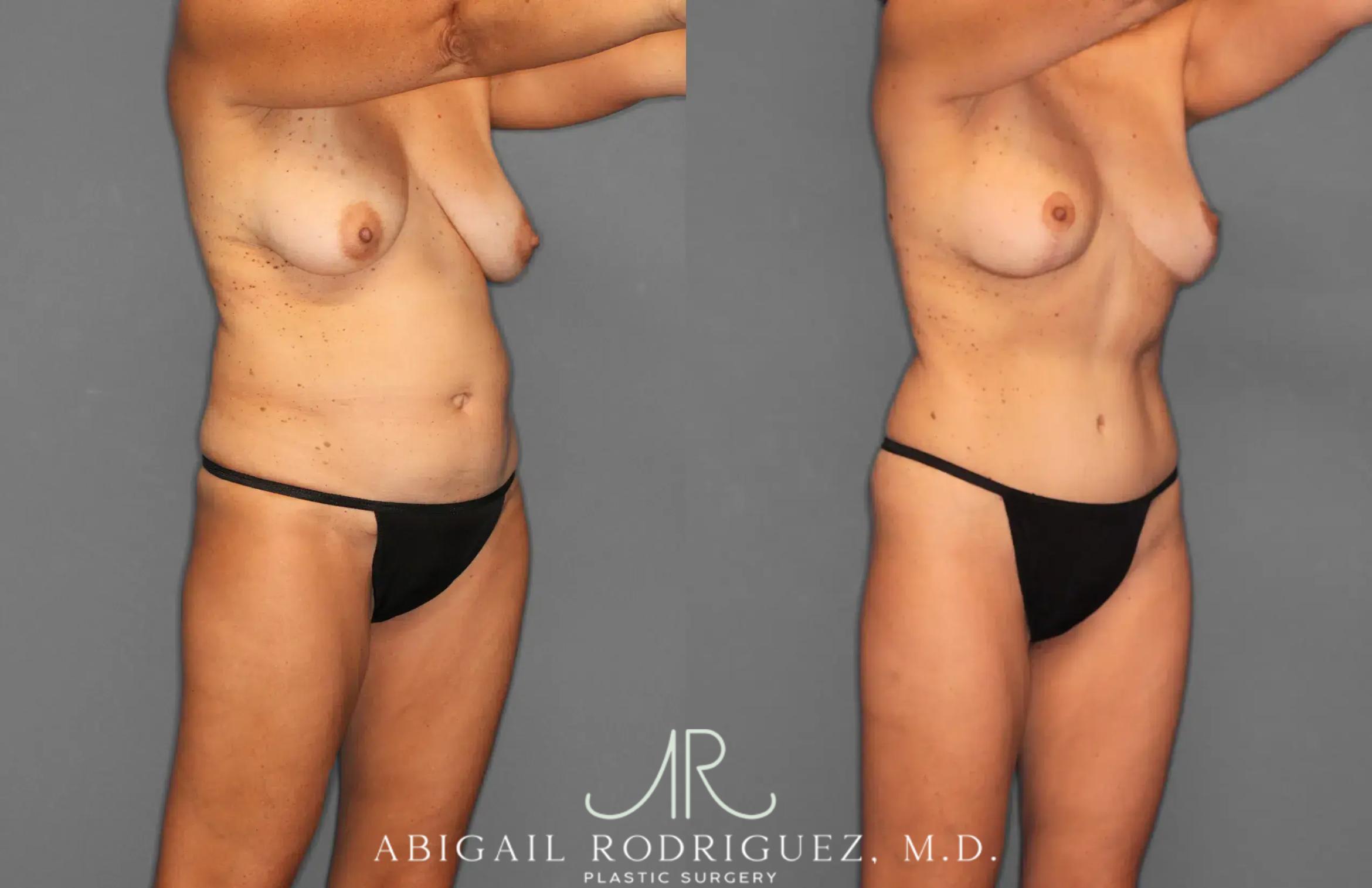 Before & After Tummy Tuck Case 259495 View 9 View in Houston, TX