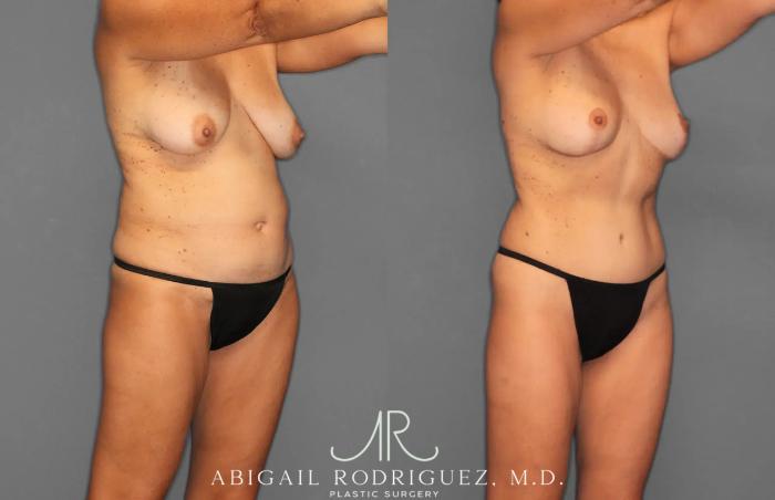 Before & After Tummy Tuck Case 259495 View 9 View in Houston, TX