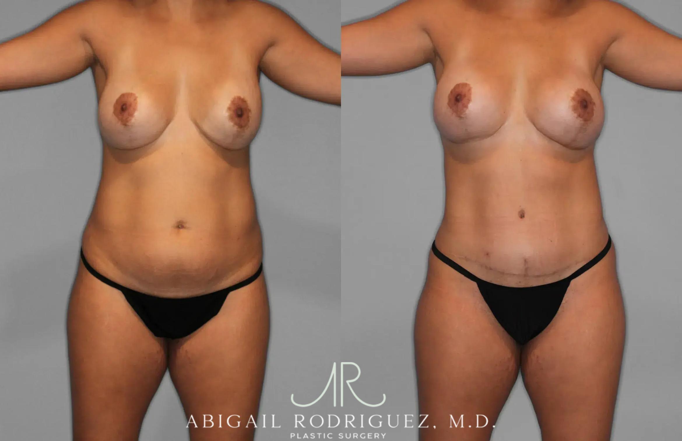 Before & After Tummy Tuck Case 259529 View 1 View in Houston, TX