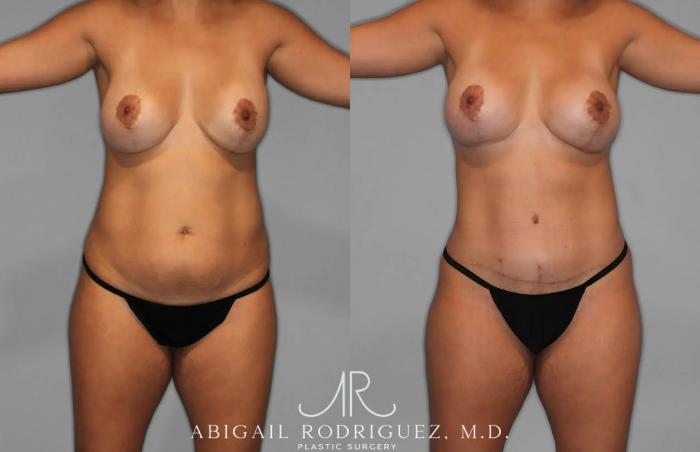 Before & After Tummy Tuck Case 259529 View 1 View in Houston, TX