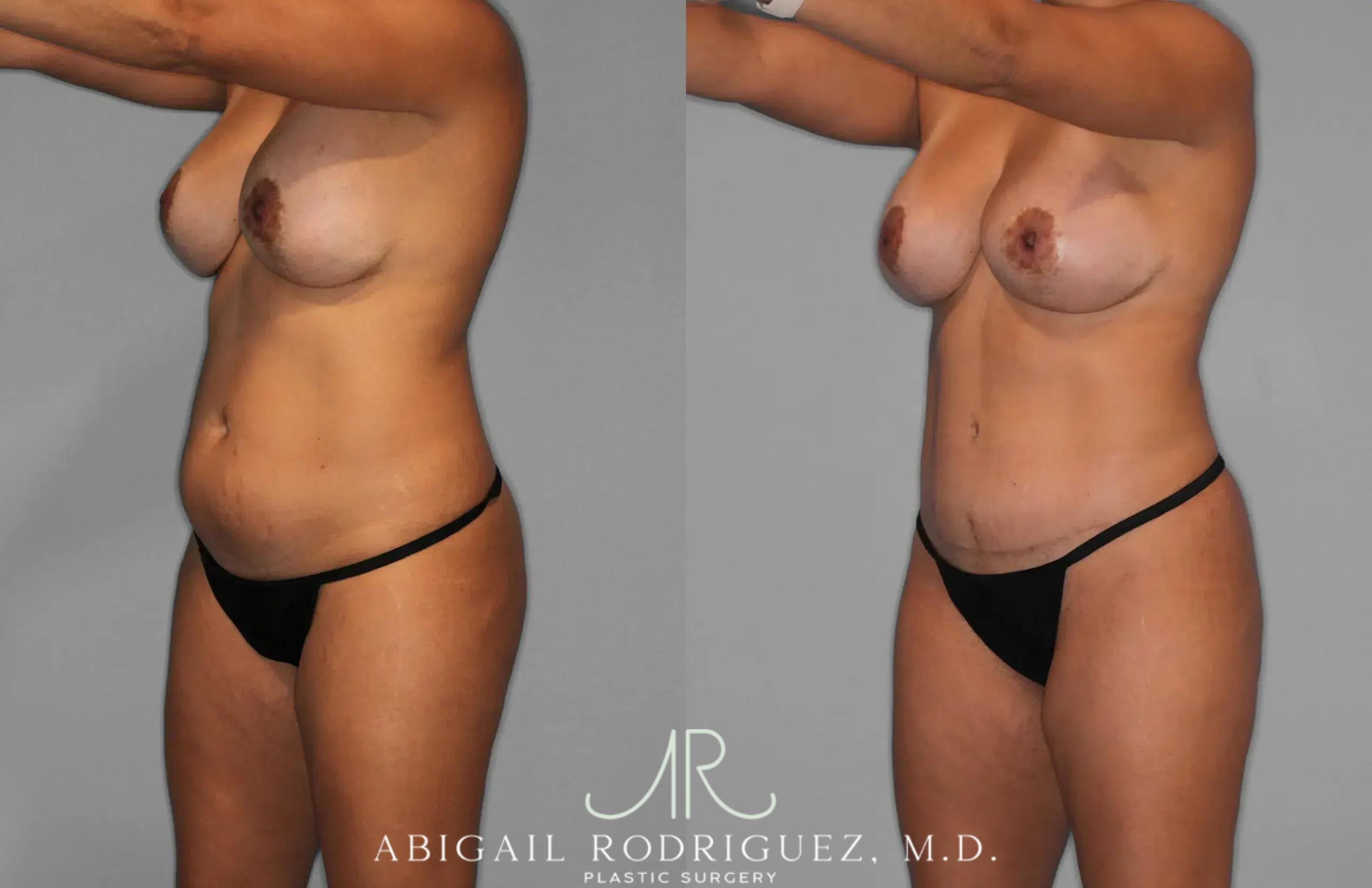 Before & After Tummy Tuck Case 259529 View 2 View in Houston, TX
