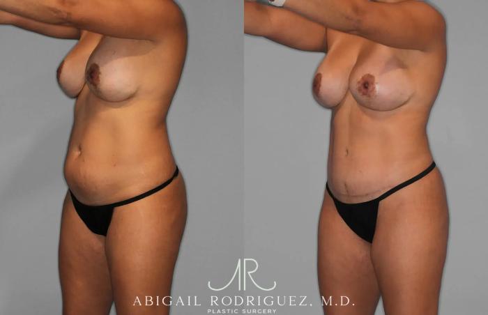 Before & After Tummy Tuck Case 259529 View 2 View in Houston, TX