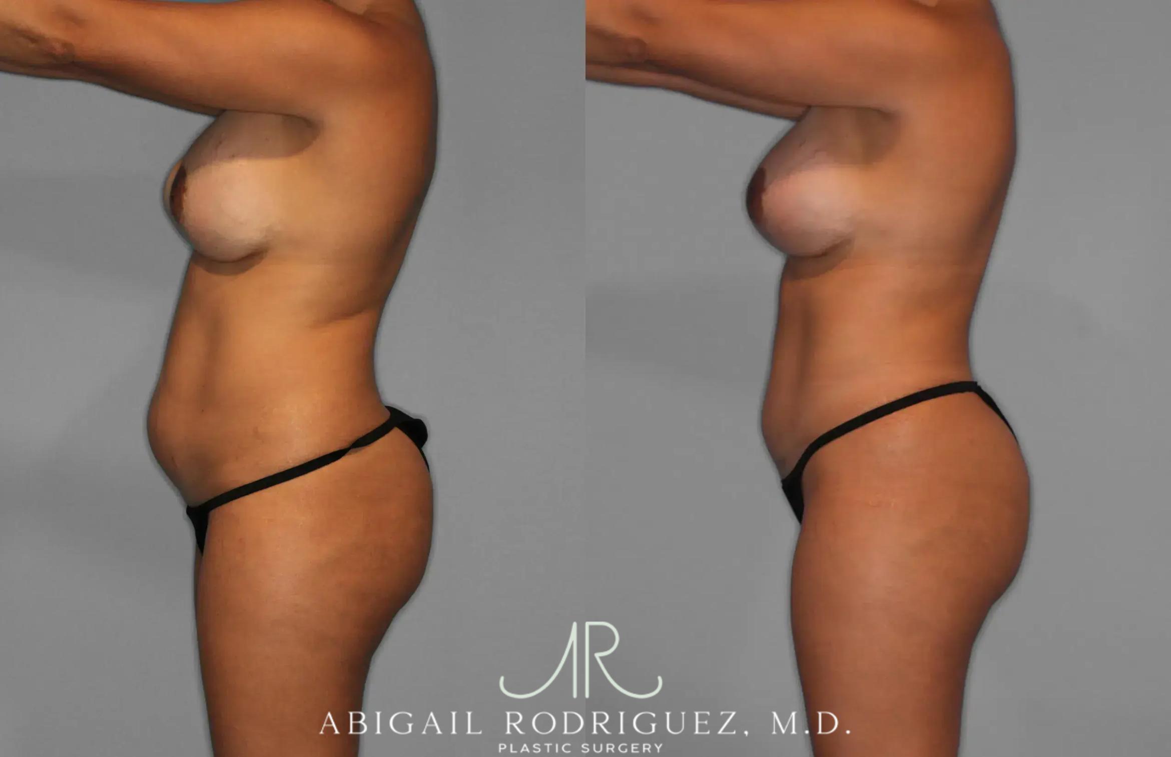 Before & After Tummy Tuck Case 259529 View 3 View in Houston, TX