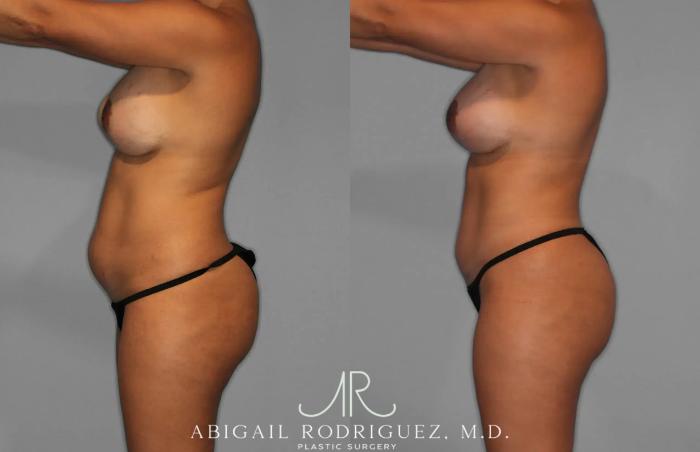 Before & After Tummy Tuck Case 259529 View 3 View in Houston, TX
