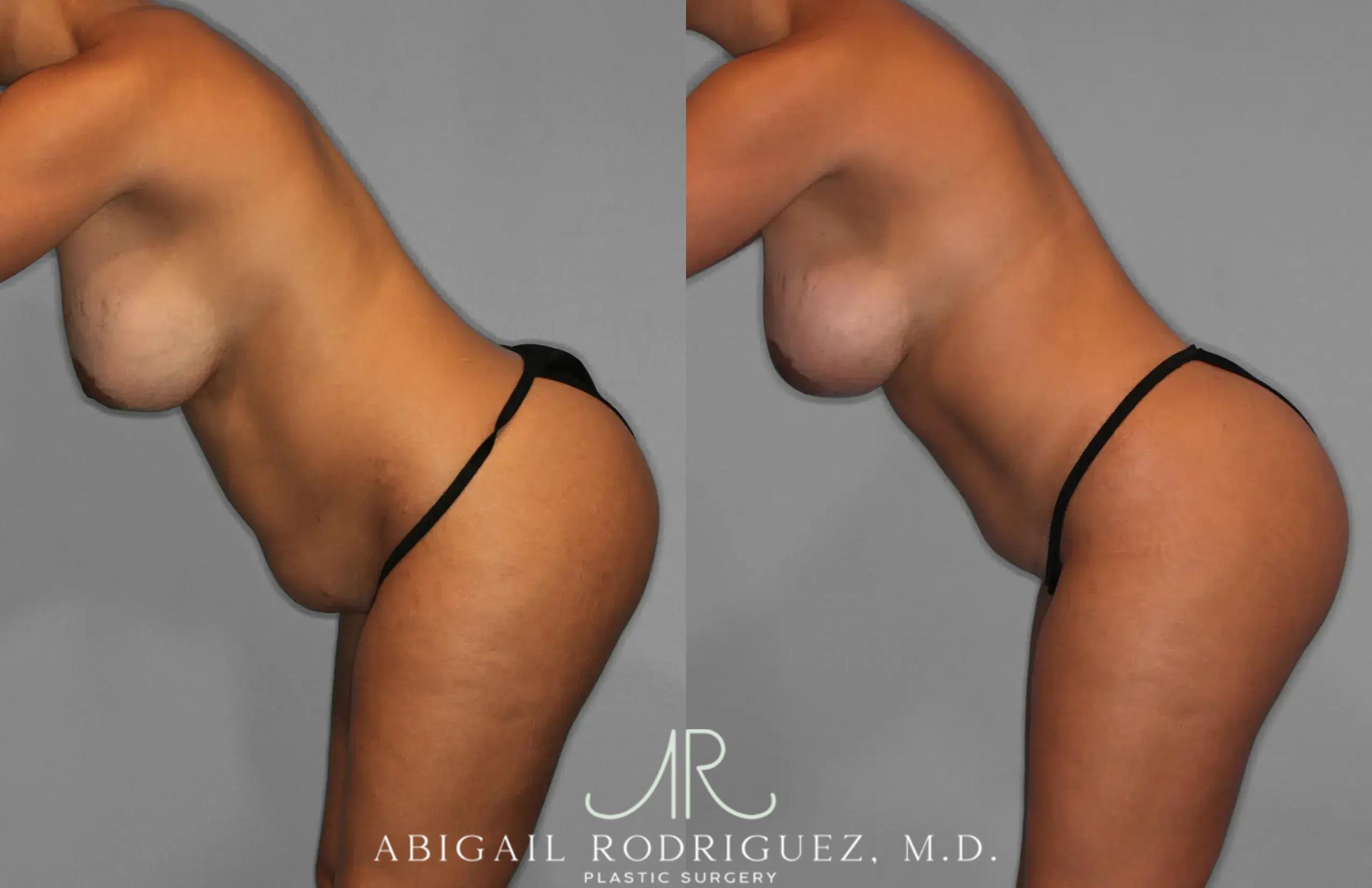Before & After Tummy Tuck Case 259529 View 4 View in Houston, TX
