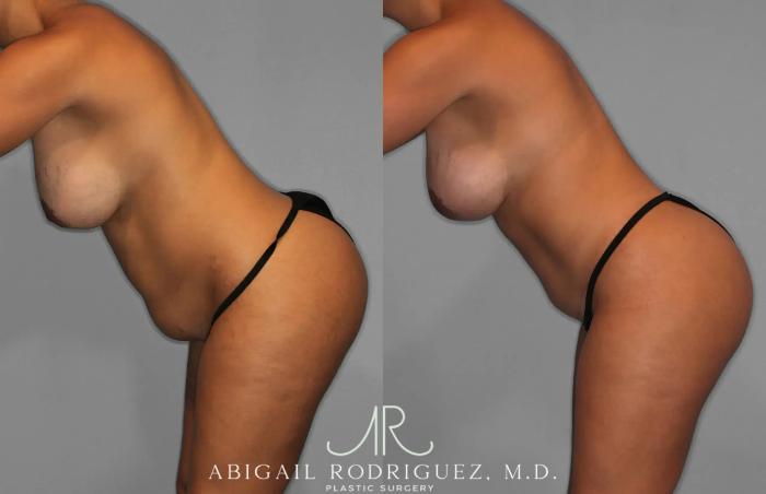 Before & After Tummy Tuck Case 259529 View 4 View in Houston, TX