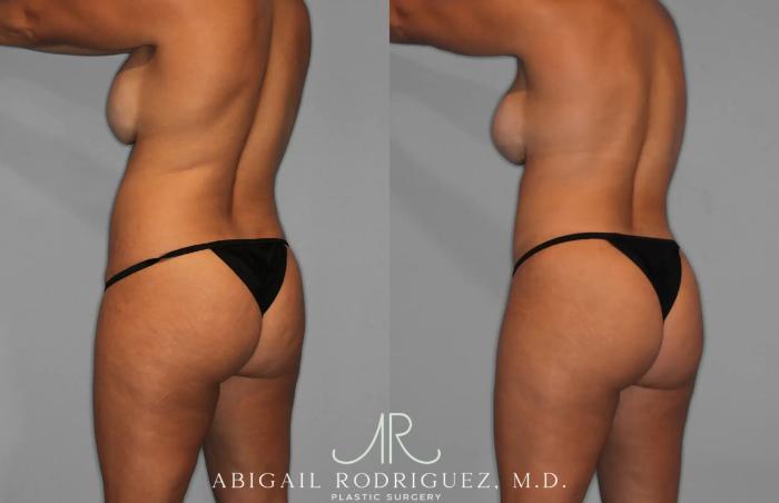 Before & After Tummy Tuck Case 259529 View 5 View in Houston, TX