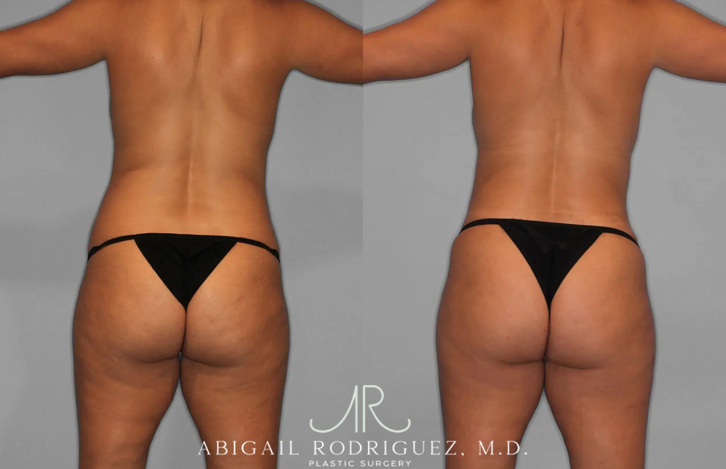 Before & After Tummy Tuck Case 259529 View 6 View in Houston, TX