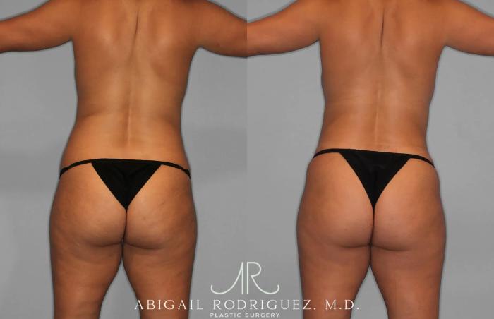 Before & After Tummy Tuck Case 259529 View 6 View in Houston, TX
