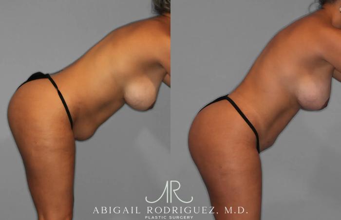 Before & After Tummy Tuck Case 259529 View 7 View in Houston, TX