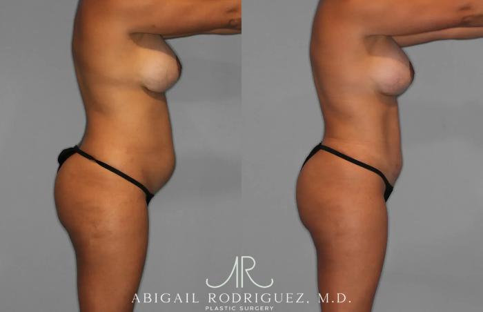 Before & After Tummy Tuck Case 259529 View 8 View in Houston, TX
