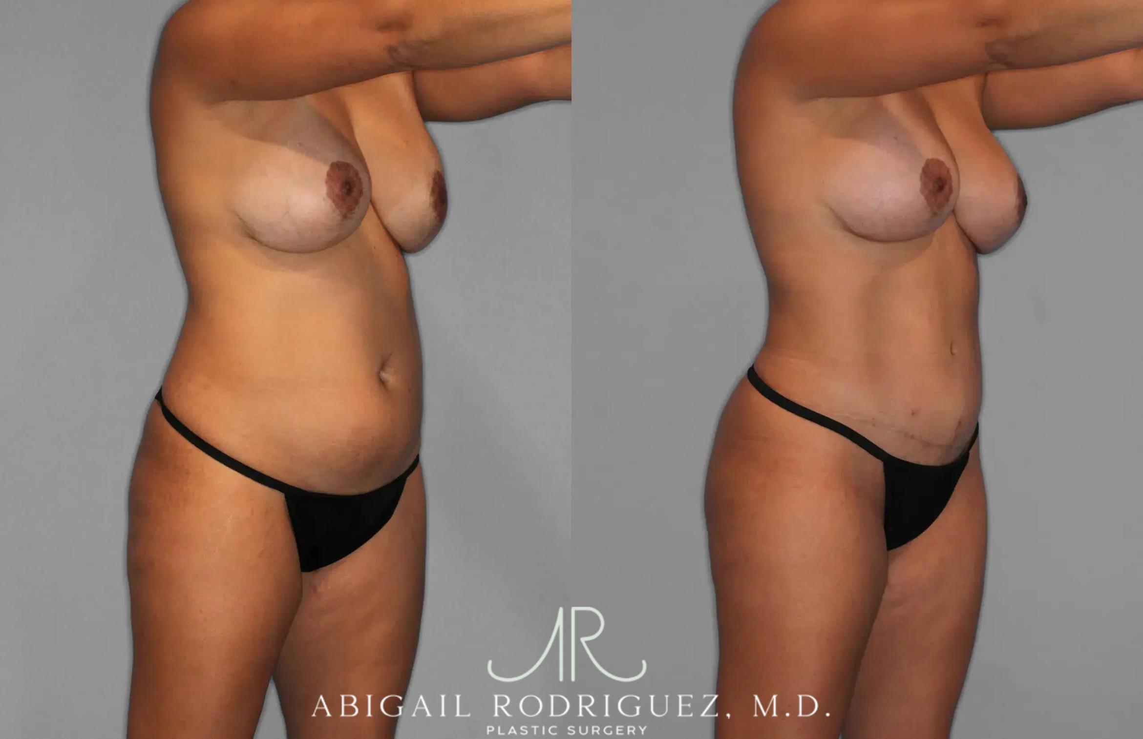 Before & After Tummy Tuck Case 259529 View 9 View in Houston, TX