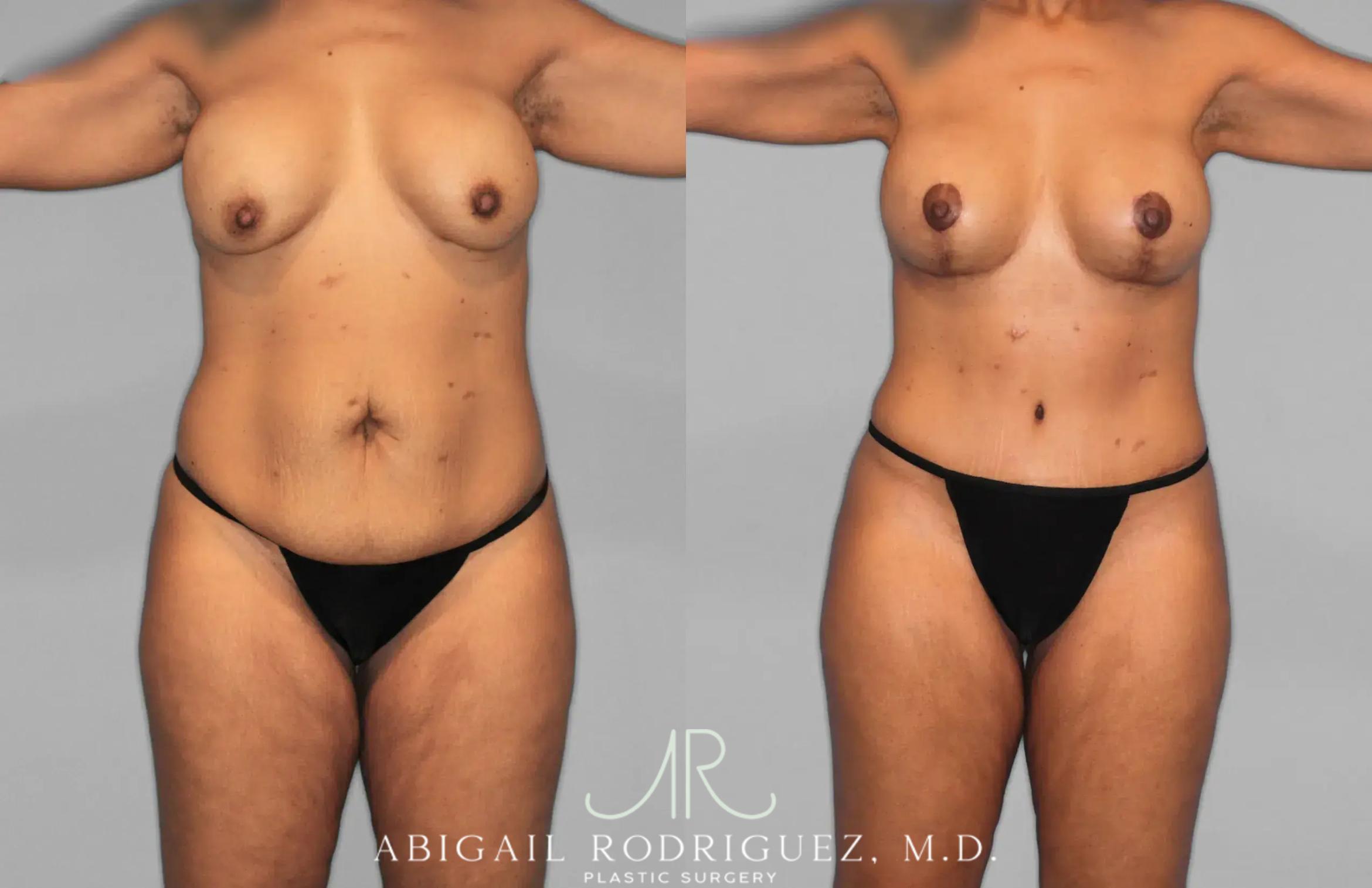 Before & After Tummy Tuck Case 259562 View 1 View in Houston, TX