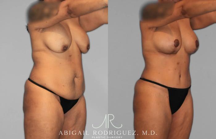 Before & After Tummy Tuck Case 259562 View 10 View in Houston, TX