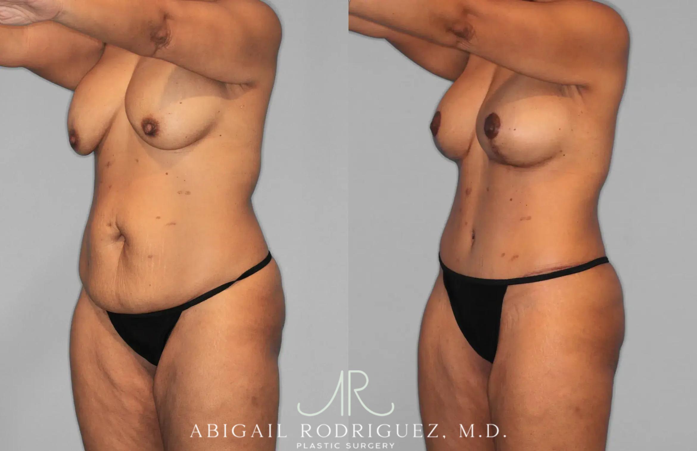 Before & After Tummy Tuck Case 259562 View 2 View in Houston, TX