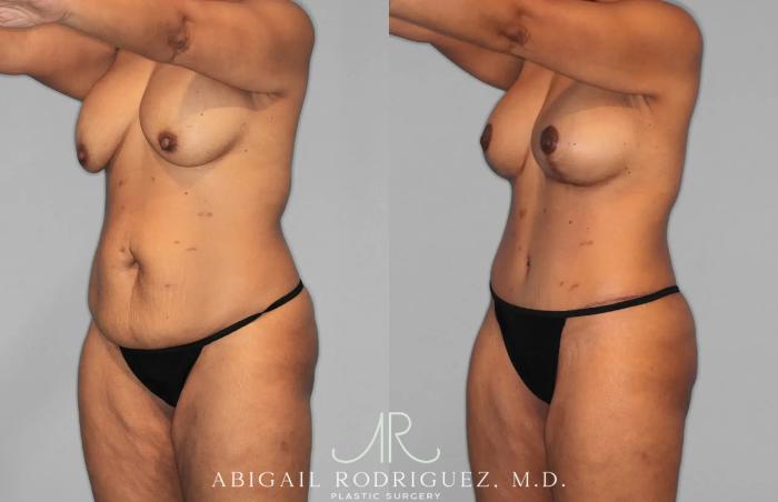Before & After Tummy Tuck Case 259562 View 2 View in Houston, TX