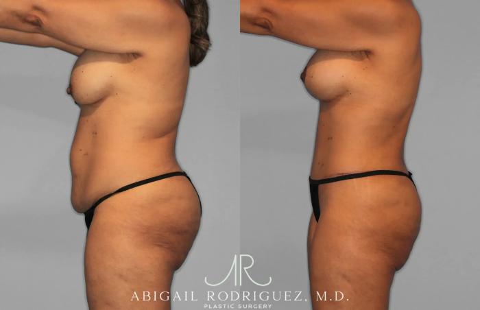 Before & After Tummy Tuck Case 259562 View 3 View in Houston, TX