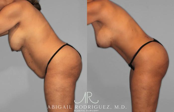 Before & After Tummy Tuck Case 259562 View 4 View in Houston, TX